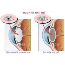 PHẪU THUẬT ĐỤC THỦY TINH THỂ TIẾN HÀNH NHƯ THẾ NÀO?