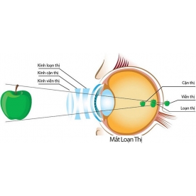 LOẠN THỊ GIÁC MẠC