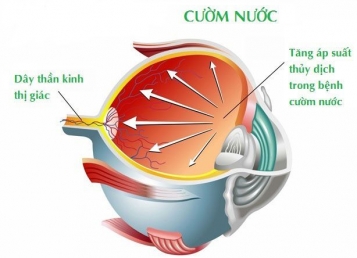 Khám và điều trị Glaucona - Cườm ước