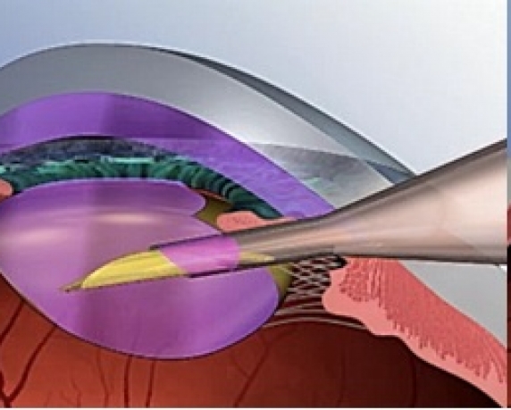 Phẫu thuật phaco